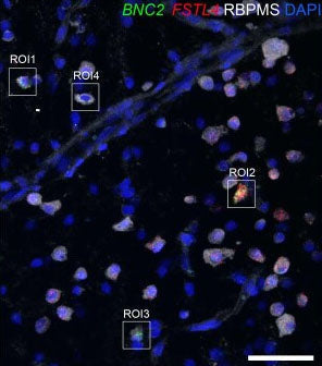 Representative confocal image of a horizontal section of the macaque ganglion cell layer immunolabeled with a pan-RGC marker (RBPMS, white) and probed by RNA in situ hybridization for BNC2 (green) and FSTL4 (red) mRNA. Nuclei are counterstained with DAPI. Image from publication CC-BY-4.0.