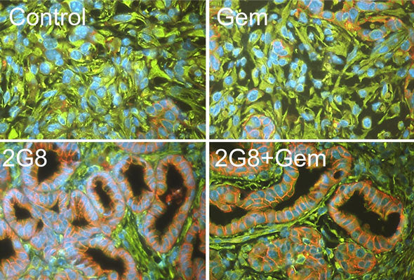 Immunostaining of tumors and precursor PanIN lesions from 4 week old LSL-KrasG12D; Cdkn2alox/lox; p48Cre (KIC) mice that were treated with 2G8 and/or gemcitabine, Gem. (Anti-Vimentin, green; Anti-E-cadherin, red). Photo courtesy of Rolf Brekken, University of Texas Southwestern. CC-BY-4.0