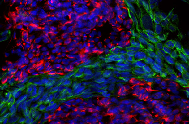 Immunoflourescence of mixed fibroblasts and PC12 cells labeled with anti-peripherin red, 1:500) and anti-vimentin green, 1:10,000). The blue is Hoechst staining nuclear DNA. Peripherin is labeled in only the PC12 cells cytoplasmic filaments and vimentin is only labeled in the fibroblasts intermediate filaments where peripherin is not present.