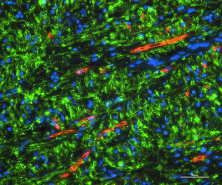 Remyelinated lesion of index case stained for PLP (green) and Pzero (red), showing that the myelin is distinctly from oligodendrocyte or Schwann cell origin, respectively. Image courtesy of Bryan Bollman, Washington University in St. Louis.