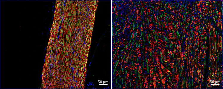 Immunofluorescence of a section of injured (right, crushed) and normal (left) mouse sciatic nerve labeled with Anti-P-Zero Myelin Protein (1:1000, red), colabeled with Anti-Neurofilament NF-L (green), and DAPI labeling nuclei. Scale bar, 50 μm; Magnification, 20×. Image kindly provided by Prem Kumar, Department of Orthopedics and Rehabilitation, Penn State University College of Medicine, John C. Elfar lab.