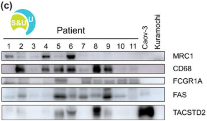 Western blotting for selected HGSC‐specific EV‐associated proteins on U fractions of 11 patients and Caov‐3 and Kuramochi HGSC cell lines. Caov‐3 and Kuramochi cells are used as negative controls for macrophage markers MRC1, CD68, and FCGR1A. For TACSTD2 (1:500), Caov‐3 serves as a positive control, while Kuramochi serves as a negative control. Image from publication CC-BY-4.0. PMID: 38490958